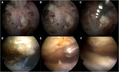 The effect of subacromial decompression on the curative effect of arthroscopic treatment of shoulder calcific tendinitis